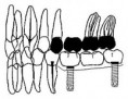 /album/prosthodontics/prosthodontois-5-jpg/